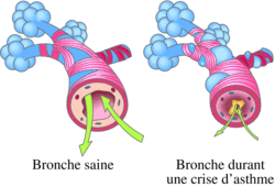 Pathologies liées à la qualité de l'air et à une anomalie génétique - illustration 2