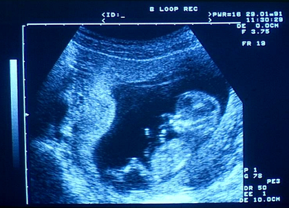 Échographie du foetus - illustration 1
