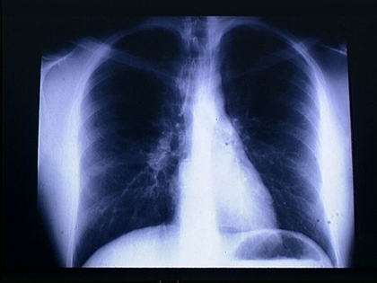 Radiographie du thorax - illustration 1