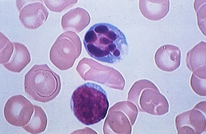 Frottis sanguin montrant un lymphocyte en apoptose - illustration 1