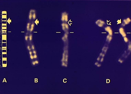 Chromosomes X dans la myopathie de Duchenne - illustration 1