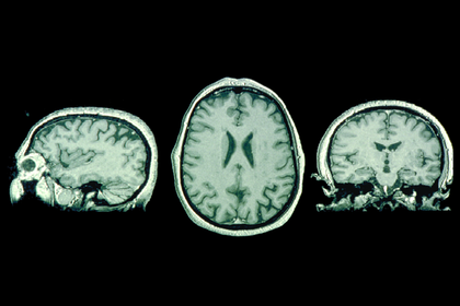 Images du cerveau obtenues par IRM anatomique - illustration 1